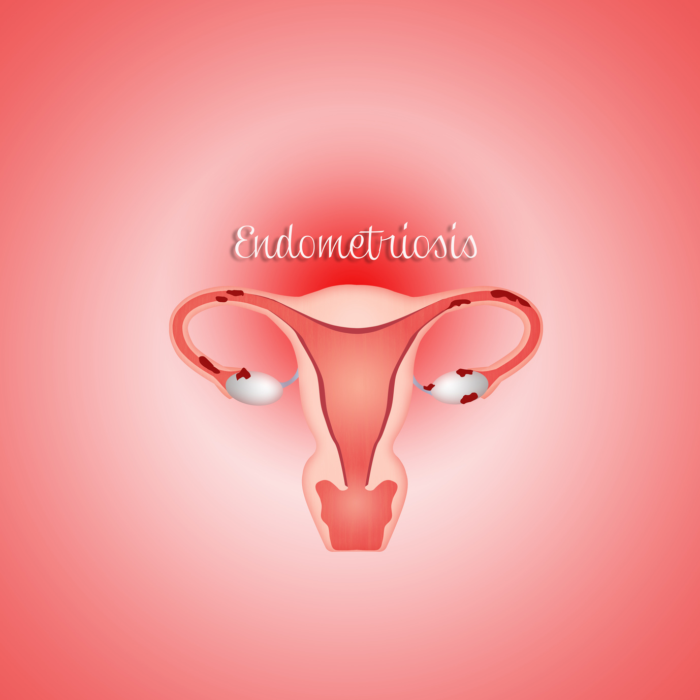 symptoms of endometriosis